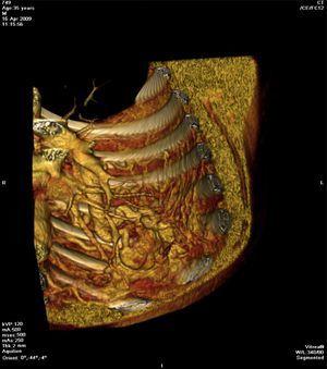 Koronalna skośna rekonstrukcja TK 3D ukazująca splot naczyń tętniczych (częściowo zewnątrzopłucnowych, przezpłucnowych i wewnątrzpłucnowych) odprowadzających przez miąższ przezbłonowy do lewej tętnicy płucnej.