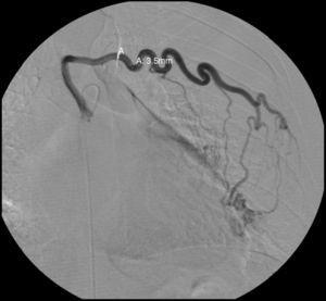 Obraz angiografii selektywnej 4. lewej tętnicy międzyżebrowej wykazujący zwiększony kaliber i krętość tętnicy międzyżebrowej.