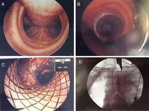 Non-invasive method for airway clearance in a patient with excessive