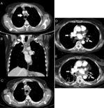 (A) Computed tomography image with contrast showing a pretracheal retrocaval mediastinal adenopathy with well-delimited necrotic center (white arrow). (B) and (C) Computed tomography images with contrast in coronal and axial planes showing mediastinal collections at left paratracheal (black arrow) and necrotic 2R adenopathy (white arrows) with thick wall enhancing. (D) Computed contrast tomography image showing small hilar (white arrows) and subcarinal (black arrows) adenopathies with punctate calcifications. (E) Contrast computed tomography image several days after EBUS, showing subcarinal liquid collection with peripheral enhancement (arrows).