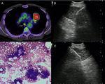 a) 56-year-old patient with a PET-positive pulmonary tumor in the left upper lobe suspicious of primary lung cancer (TU). In lymph node station 7 (LN7) there is increased FDG-uptake; (b) EBUS image of the lymph node in station 7; (c) corresponding EUS-B image of the same lymph node from esophagus with the same bronchoscope; (d) cytological image of the EUS-B-NA showing adenocarcinoma cells with background blood (courtesy of Cynthia van der Horst, MD, Glasgow, UK).