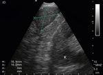 EUS-B image of an enlarged left adrenal gland. The adjacent kidney is visible at the right lower corner (K).