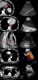 CT view and EUS-B view of the main anatomic landmarks (Ao – aorta, D – diaphragm, H – heart, L – liver, LA – left atrium, Lu – lung, PA – pulmonary artery, SA – subclavian artery, V – vertebra).