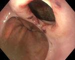 Endoscopic image of the distal esophagus after EUS-B-NA shows a large iatrogenic perforation of the esophageal wall close to the cardia.