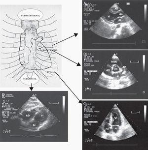 Schematic representation of windows and images obtained by transthoracic echocardiography. Parasternal longitudinal plane of the LV (1A) showing the left atrium (LA), left ventricle (LV), aorta (Ao) and right ventricle (RV). Parasternal transverse plane at major vessel level (1B), with the right ventricle outlet tract (RVOT), pulmonary artery (PA) and right atrium. Apical four-chambers plane (1C), and subcostal plane (1D) showing the right and left cavities.