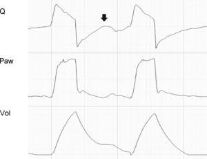 Tracing corresponding to a patient with pressure support ventilation. Note the ineffective inspiratory effort (arrow).