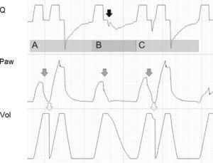 Tracing corresponding to a patient with conventional mechanical ventilation exhibiting a neural Ti greater than the mechanical Ti. In cycle A and in cycle C, the phenomenon is of sufficient magnitude to produce double cycling, while in cycle B, although there is amputation of peak expiratory flow (black arrow), the patient effort proves unable to again trigger the ventilator. The Paw tracing shows marked differences in the first and second inspirations in the cycles where double cycling is observed: while the first shows amputation of the inspiratory plateau (effort persists with the inspiratory valve closed, gray arrows), the second shows a clear plateau and much higher Paw values (the inspiratory effort of the patient has ended, and tidal ventilation has doubled). The doubling of tidal ventilation is not seen in the Vol tracing because the system software adjusts zero at the start of the second inspiration (hollow arrows).