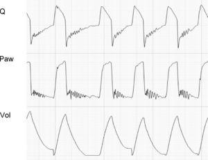 Tracing corresponding to a patient with pressure support ventilation. The Q tracing shows oscillations characteristic of the presence of secretions in the airway. In some cases such as this case, the phenomenon can also be seen in the Paw tracing.