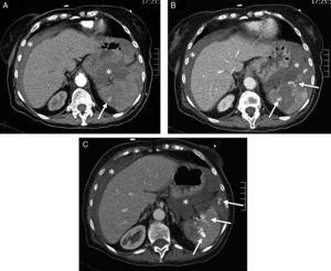Splenic damage. A 77-year-old woman subjected to anticoagulation, who suffered a fall at home as a result of “dizziness”. In the emergency room she presented hypotension and abdominal distension. (A) WBCT with contrast, axial acquisitions of the upper abdomen in arterial phase. (B and C) Imaging in venous phase. Hemoperitoneum (*). Intravenous contrast leakage into splenic parenchyma and peritoneal cavity (arrow), increasing in size and density in the portal phase (b and c) due to splenic laceration with active bleeding.