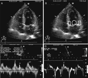 Echocardiographic assessment of left ventricular diastolic function. (A) Apical four-chamber view. In this view must check the left atrium volume and size and the left ventricle and septum size. (B) Apical four-chamber view, circle shows position where pulse wave Doppler has to be placed to measure transmitral flow, whereas rectangles show position where tissue Doppler must be placed to measure the velocity of change in myocardial length. (C) Pulse wave mitral Doppler at the tip of the mitral valve showing a normal diastolic pattern with a biphasic velocity profile E and A waves. Measurement of E wave deceleration time. (D) Tissue Doppler measurement at the lateral insertion site of the mitral leaflets shows the diastolic e′ and a′ waves and systolic s′ wave. LA, left atria; RA, right atria; LV, left ventricle; RV, right ventricle; DT, deceleration time.