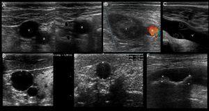 US mapping before cannulation. (A) Patent vein, confirmed by full compressibility (arrows); (B) thrombosed common femoral vein, clearly seen enlarged and occupied by a large thrombus (t); a: common femoral artery. (C) vein valve; v: vein; (D) optimal vein diameter for central venous cannulation; (E) optimal vein diameter and distance from skin to vein for peripheral vein cannulation; (F) artery with two calcified atheromatous plaques (calipers).