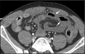 Abdominal CT scan showing the absence of intravenous contrast uptake in a jejunal segment, suggestive of ischemia (arrows).