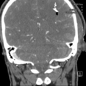 Coronal CT reconstruction: posttraumatic thrombosis in the left transverse sinus.