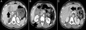 (A) The arrow shows one hypodense area in the hepatic segment V that is consistent with the hepatic lesion reported. (B) The arrow shows one right renal lesion at posterior-superior level. (C) The control CT scan conducted at day 8 confirms that the hepatic lesion has reduced its size and shape.