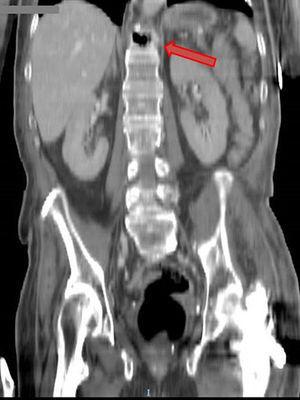 Sagittal CT scan of the abdomen.