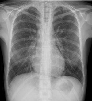 Chest X-ray at admission showing pneumomediastinum and subcutaneous emphysema on the neck.