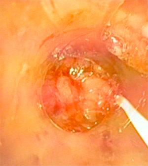 View of tracheal lumen through fibrobronchoscopy.