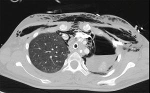 Thoracic CT scan image. View of tracheal prosthesis, left hydropneumothorax, pneumomediastinum, and extensive subcutaneous emphysema.