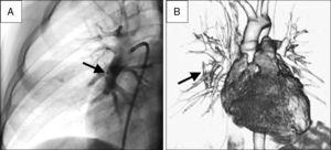 (A) Post-procedure angiography. Look at the permeability of the pulmonary vessels distal to the device (arrow). (B) Control CT scan (6th month). 3D reconstruction showing occlusion of pulmonary artery pseudoaneurysm (arrow).