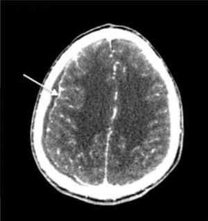 Cranial CT scan with contrast (axial slice). Right subdural hypodense extra-axial collection with peripheral enhancement and mass effect.