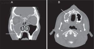 Craniofacial CT scan (coronal slice 2A and axial slice 2B). Invasion of right maxillary sinus including cystic lesion suggestive of periapical cyst (arrow). Ipsilateral frontal pneumocephalus.