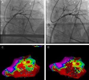 Pre- (A) and postoperative coronary intervention fluoroscopy (B). Endocardial voltage mapping showing inferior–lateral scar. Electrogram areas with isolated or potentially delayed components (C, blue dots) and ablation sites (D, red dots). c: ECMO venous cannula; p: electrophysiology mapping and imaging catheter.