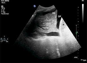 Lung ultrasound showing hypoechogenic pleural effusion (PE), liver (L), and pulmonary parenchyma (PP) with the fluid bronchogram sign (arrows) where the bronchi show lack of air inside.