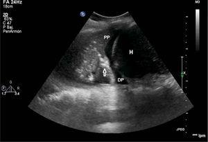 Lung ultrasound showing hypoechogenic pleural effusion (PE), liver (L), and pulmonary parenchyma (PP) with the air bronchogram sign (arrows) where the air-filled bronchi look like dark lines inside one lung consolidation.