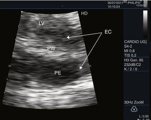 Transverse parasternal plane with zoom at posterior wall level. PE: pericardial effusion; EC: echo-contrast; PW: posterior wall; LV: left ventricle.