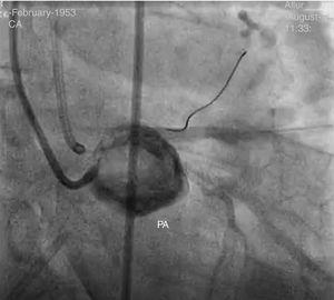 The coronary angiography confirms the presence of pseudoaneurysm (PA) of the coronary fistula.