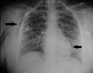 Chest X-ray prior to VV-ECMO. The arrows show the pneumopericardium and interstitial and subcutaneous emphysema.
