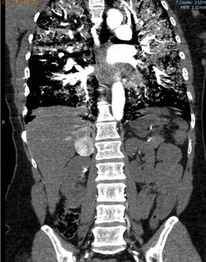 TAC thoraco-abdominal CT scan with contrast with bilateral alveolar occupation imaging and right suprarenal hyperuptaking lesion.
