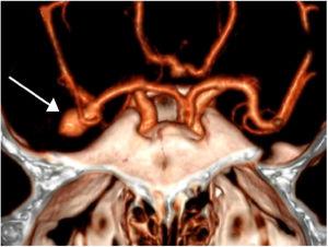 Cranial CTA. Aneurysmal lesion dependent on the bifurcation of the right middle cerebral artery (arrowhead).