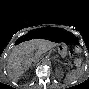 Abdominal CAT scan showing pneumoperitoneum.