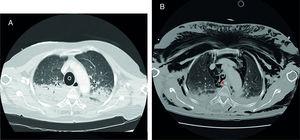 (A) Initial thoracic CT scan. (B) Thoracic CT scan at the ICU.