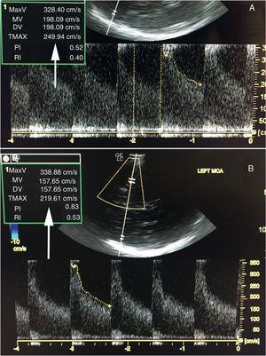 Measurement of mV in left MCA. TCD ultrasound before the block (A) and after the block (B).