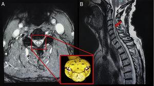 T2-weighted MRI images. The axial slice reveals one snake eye-lesion suggestive of spinal cord infarction. The sagittal slice shows pencil-like signal hyperintensity.