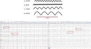 Normal brain waves. (a) Alpha (8–12Hz), (b) Beta (13–30Hz), (c) Zeta (4–7Hz), (d) Delta (0.1–3Hz).
