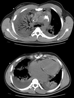 Computed tomography scan: alveolar consolidation at the level of the right upper lobe of the lung and moderate mediastinal hematoma.