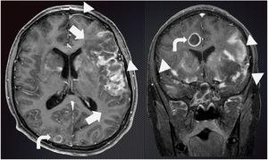 Magnetic resonance imaging view of the brain in transverse and coronal section.