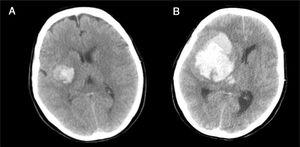 (A) Initial brain CT scan revealing minor hemorrhage affecting the right basal ganglia, with partial collapse of the ipsilateral ventricular system. (B) Repeat CT scan 4h after the first, showing massive right hemispheric hemorrhage, ventricular invasion and signs of subfalcine herniation.