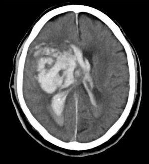 Brain CT scan revealing a large intraparenchymal hematoma in the right basal ganglia, with midline displacement and invasion and dilatation of the ventricular system.