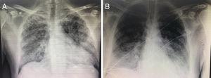 X-ray image of a patient infected with SARS-CoV-2. A) Bilateral pneumonic infiltrates typical of COVID-19. B) Disease progression of the same patient after orotracheal intubation and connection to mechanical ventilation.