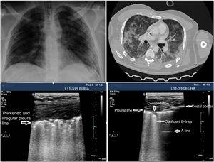 Patient admitted to the ICU with pneumonia due to SARS-CoV-2. Patient with pneumonia due to SARS-CoV-2 of 2-week duration with clinical improvement and as seen on the simple x-ray. However, there is presence of persistent pathological findings on the pleural ultrasound and CT scan.