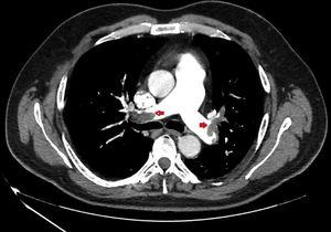 Computed tomography scan of a patient. Axial view at the pulmonary artery bifurcation, showing a thrombus in the distal portion of both principal pulmonary arteries and in the lobar artery of the left upper lung lobe.