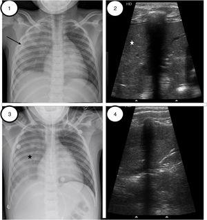 Patient 1. (1) Initial chest radiography preceding alveolar recruitment, right coalescent opacities with right pleural effusion (black narrow). (2) Lung ultrasound image preceding lung recruitment, exhibiting diffuse abnormal pulmonary aeration with condensation pattern (white star) on the right anterior, lateral and posterior regions. (3) Chest-X radiography after VNI recruitment. Similar coalescent opacities in right lung (black star) without pleural effusion. (4) Lung ultrasound reveals the presence of sonographic air bronchograms representing air-filled bronchi with linear, hyperechoic branching echoes toward pleural lung. The consolidated lung parenchyma has improved with respect to Image 2.