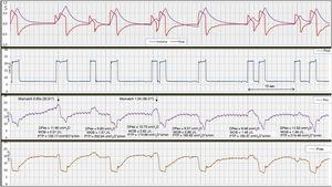 Registry (flow and volume) of Paw, Pes, and Pves signs during pressure support ventilation in case #2. In this case, we presented ventilation with double cycling defined as DTA due to auto-triggering of the ventilator preceding the patient’s respiratory driver (reverse triggering in a general sense). In this case, the patient’s cycle does not start by contracting the inspiratory muscles, but by releasing intense active expiration, as confirmed by vesical pressure. The contraction of the diaphragm comes after active exhalation release. To think that this respiratory driver that includes forced exhalation release and the patient’s inspiratory effort is the product of some reflex does not seem very likely. In this case the correlation between the mechanical and the neural cycles is variable. The parameters associated with inspiratory effort are: DPes: 11.55±1.22cmH2O, note the higher DPes in double triggering; WOB, 1.06±0.42J/L; PTP, 183.95±27.59cmH2Os/min; in this case, work of breathing was associated with the volume generated by cycle stacking corresponding to double cycling. Also, the appearance of double cycling varied.