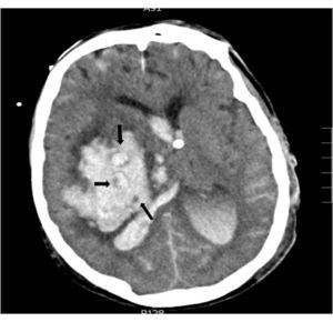 Hemorrhage in right basal ganglia with ventricular spill and brain midline shift. The inside of the hematoma shows the «whirlwind sign», the arrows point at areas of different densities; the small hypodense areas correspond to foci of active bleeding through arterioles and venules.
