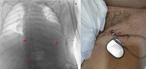 A. Chest X-ray (negative), showing the electrocatheter (red arrows) in the right ventricle via the inferior vena cava. B. Pulse generator connected to the active fixation electrocatheter placed via the femoral route.