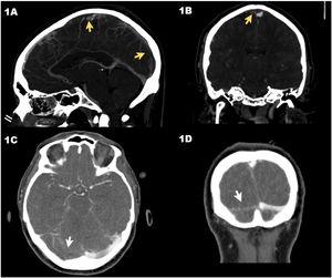 Axial computed tomography (CT) scan in venous phase (case #1) showing the thrombosis of the superior longitudinal venous sinus (arrows) in sagittal (A) and coronal (B) views. CT scan in venous phase (case #2) showing the lack of repletion of the right transverse venous sinus (arrows) in the sagittal (C) and coronal (D) views.